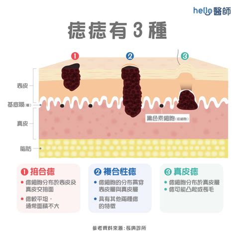 棕櫚樹種子 痣形成原因